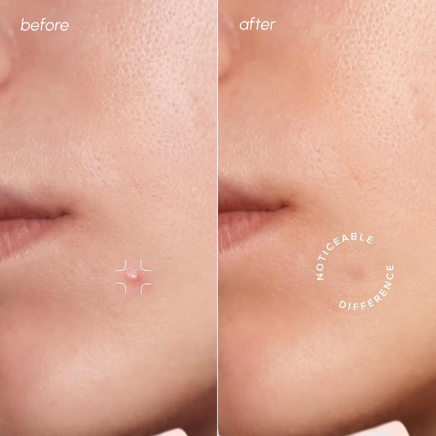 Invisible Pimple & Acne Patches - GloMode